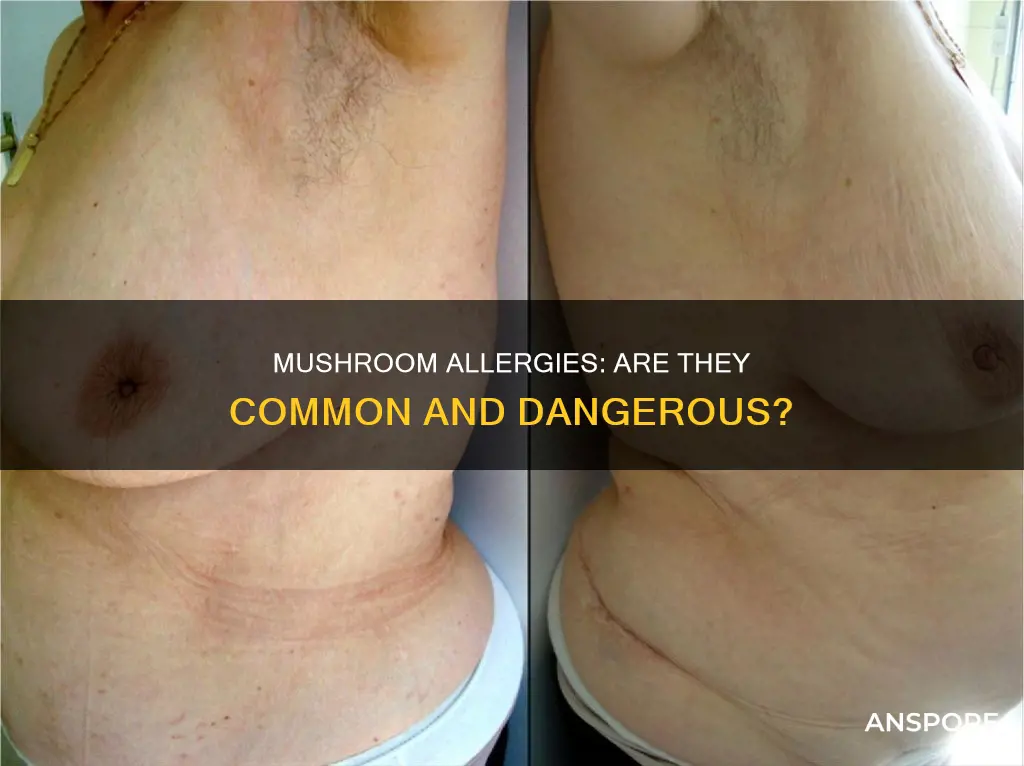 are mushroom allergic for people