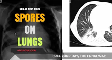 Can X-Rays Detect Fungal Spores in the Lungs? Explained