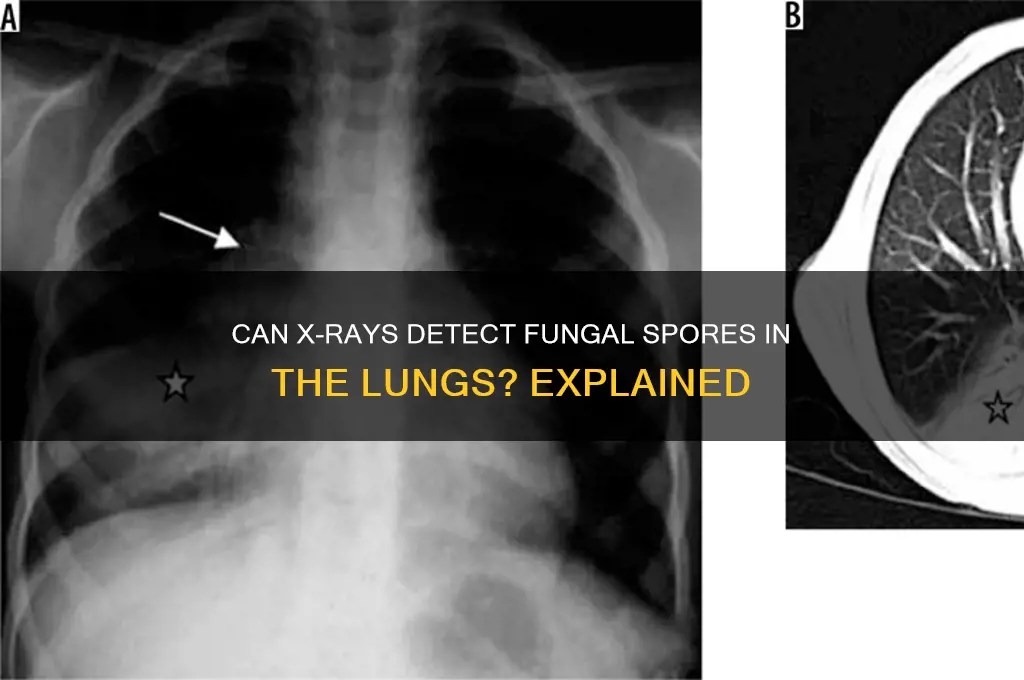 can an xray show spores on lungs