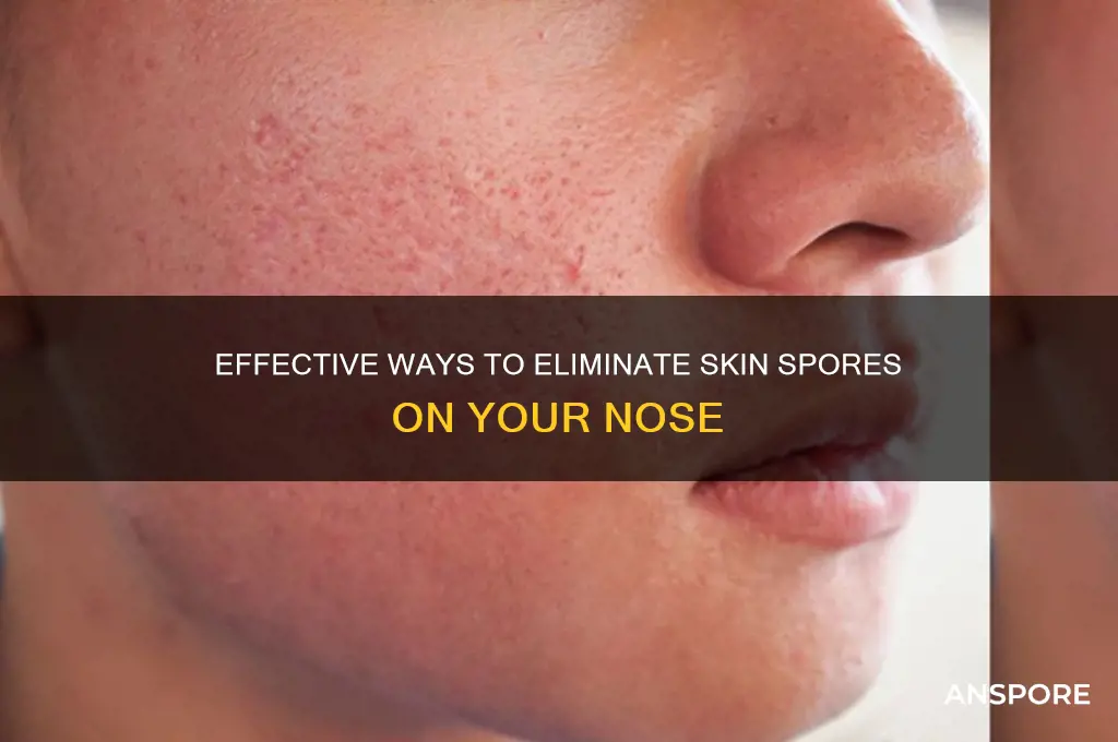 how to get rid of skin spores on your nose