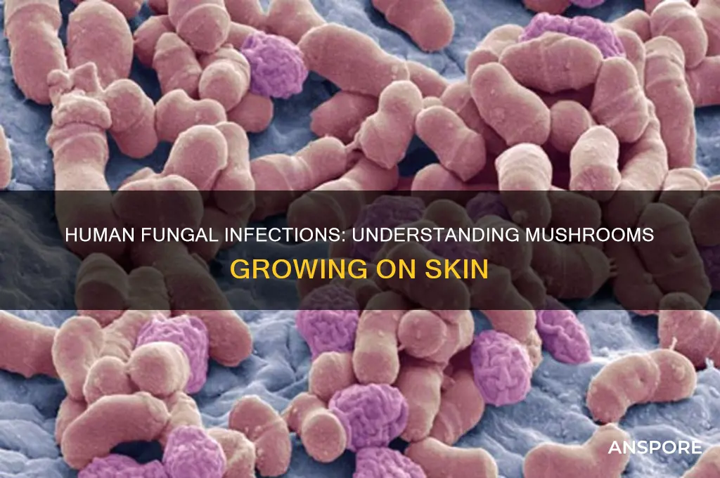 what fungus sprouts mushrooms on humans